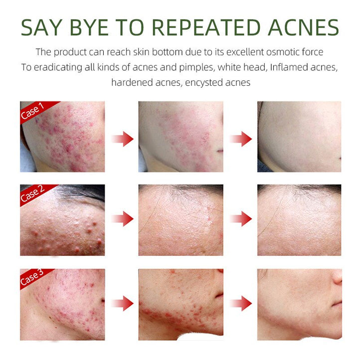 Herbal Acne Removal Face Cream
